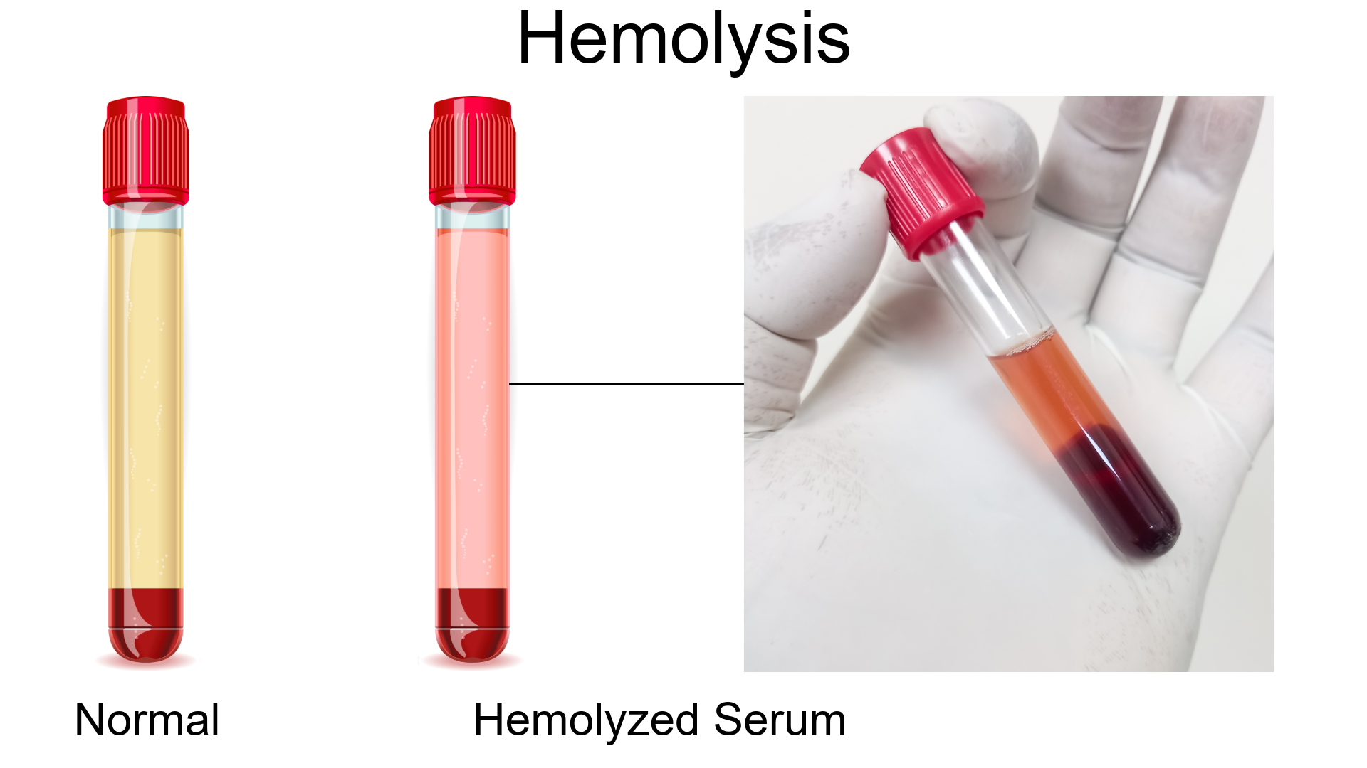 Hemolysis Example