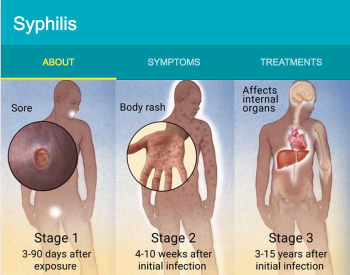 syphilis stages diagram